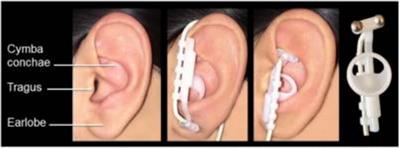 Current status of transcutaneous auricular vagus nerve stimulation for tinnitus: a narrative review of modern research